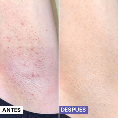 Lunéa Aceite de Cyperus Rotundus® - Vello más fino y menos visible