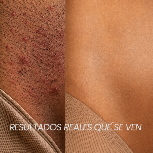 Lunéa Aceite de Cyperus Rotundus® - Vello más fino y menos visible