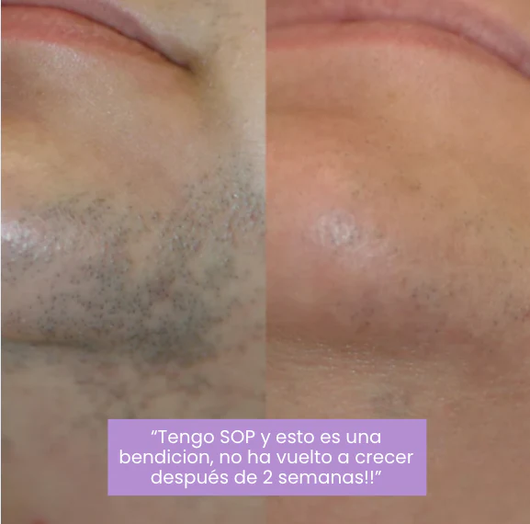 Serum Lunéa® | Frena y Debilita Tu Vello Facial Naturalmente