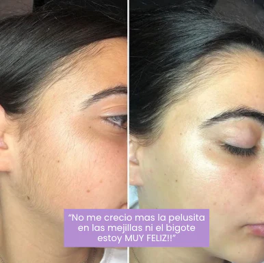 Serum Lunéa® | Frena y Debilita Tu Vello Facial Naturalmente